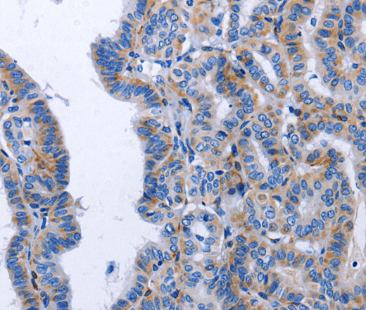 Immunohistochemistry of paraffin-embedded Human thyroid cancer tissue using BDNF Polyclonal Antibody at dilution 1:40