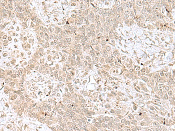 Immunohistochemistry of paraffin-embedded Human ovarian cancer tissue  using RPL35 Polyclonal Antibody at dilution of 1:70(?200)