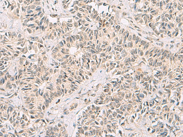 Immunohistochemistry of paraffin-embedded Human ovarian cancer tissue  using RNF13 Polyclonal Antibody at dilution of 1:60(?200)