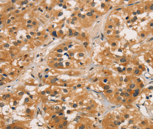 Immunohistochemistry of paraffin-embedded Human thyroid cancer tissue using CTNNBIP1 Polyclonal Antibody at dilution 1:30