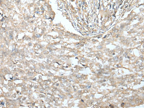 Immunohistochemistry of paraffin-embedded Human lung cancer tissue  using VILL Polyclonal Antibody at dilution of 1:65(?200)