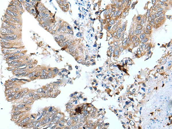 Immunohistochemistry of paraffin-embedded Human colorectal cancer tissue  using GKN1 Polyclonal Antibody at dilution of 1:30(?200)