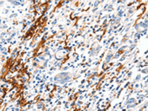 Immunohistochemistry of paraffin-embedded Human gastric cancer tissue  using VTN Polyclonal Antibody at dilution of 1:100(?200)