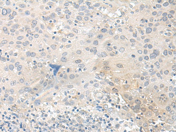 Immunohistochemistry of paraffin-embedded Human cervical cancer tissue  using TUBG2 Polyclonal Antibody at dilution of 1:50(?200)