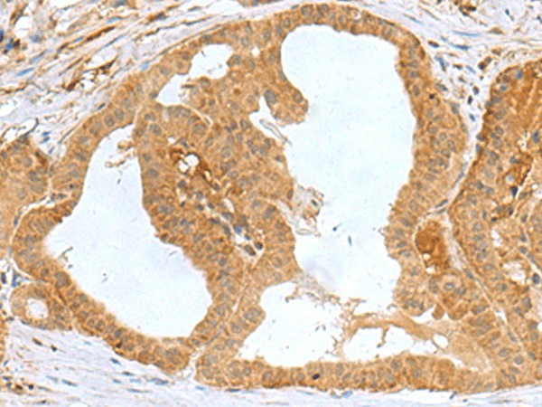 Immunohistochemistry of paraffin-embedded Human thyroid cancer tissue  using MRPS28 Polyclonal Antibody at dilution of 1:60(?200)