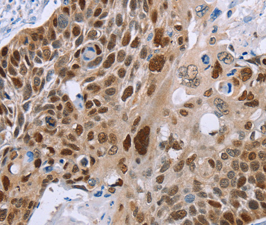 Immunohistochemistry of paraffin-embedded Human esophagus cancer using MAGEA10 Polyclonal Antibody at dilution of 1:50