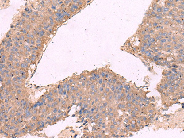 Immunohistochemistry of paraffin-embedded Human liver cancer tissue  using KCNN3 Polyclonal Antibody at dilution of 1:40(?200)