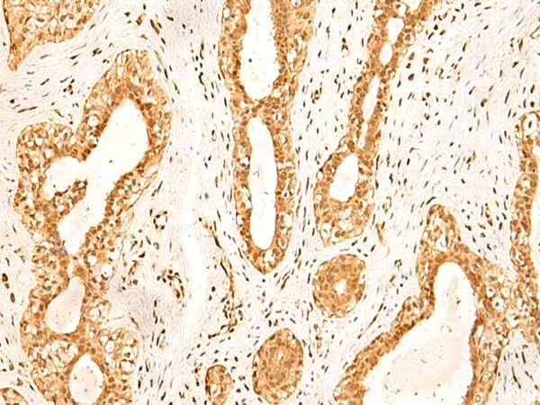 Immunohistochemistry of paraffin-embedded Human breast cancer tissue  using ZNF471 Polyclonal Antibody at dilution of 1:50(?200)