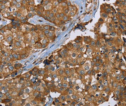 Immunohistochemistry of paraffin-embedded Human breast cancer tissue using PLXNB1 Polyclonal Antibody at dilution 1:50