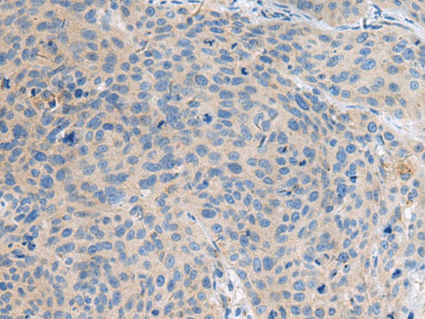 Immunohistochemistry of paraffin-embedded Human cervical cancer tissue  using KIAA0556 Polyclonal Antibody at dilution of 1:90(?200)