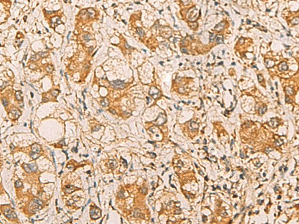 Immunohistochemistry of paraffin-embedded Human liver cancer tissue  using MRPL9 Polyclonal Antibody at dilution of 1:55(?200)