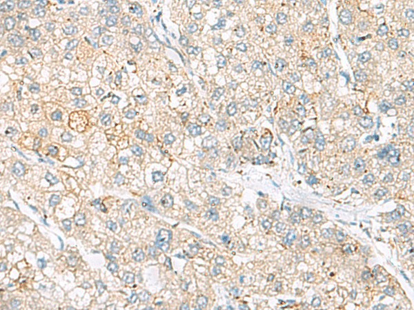 Immunohistochemistry of paraffin-embedded Human liver cancer tissue  using FARP2 Polyclonal Antibody at dilution of 1:55(?200)