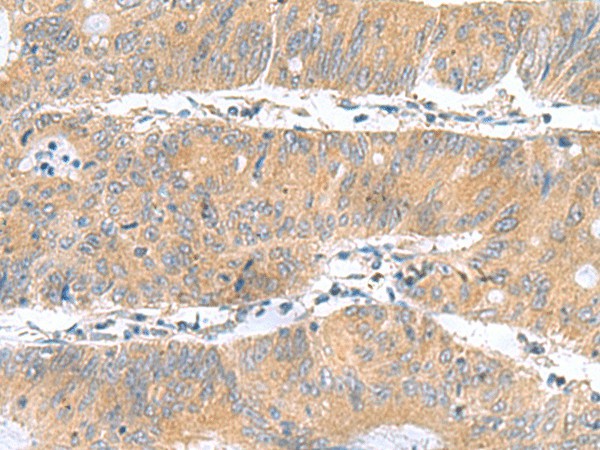 Immunohistochemistry of paraffin-embedded Human colorectal cancer tissue  using DNAL1 Polyclonal Antibody at dilution of 1:50(?200)