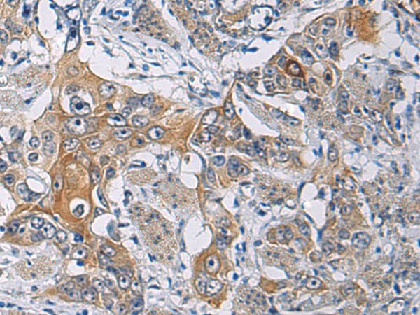 Immunohistochemistry of paraffin-embedded Human esophagus cancer tissue  using KCNJ10 Polyclonal Antibody at dilution of 1:60(?200)