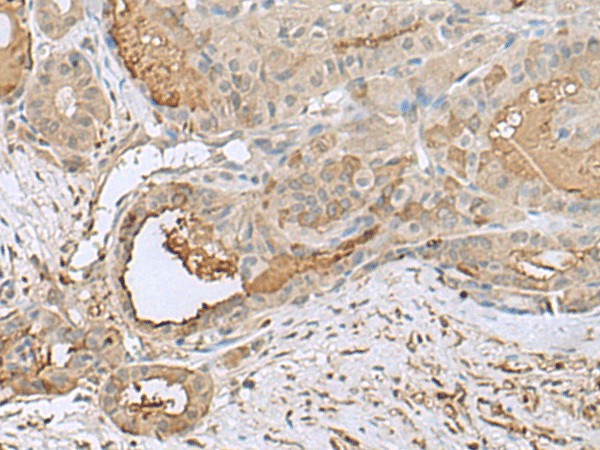 Immunohistochemistry of paraffin-embedded Human thyroid cancer tissue  using GABARAPL2 Polyclonal Antibody at dilution of 1:55(?200)