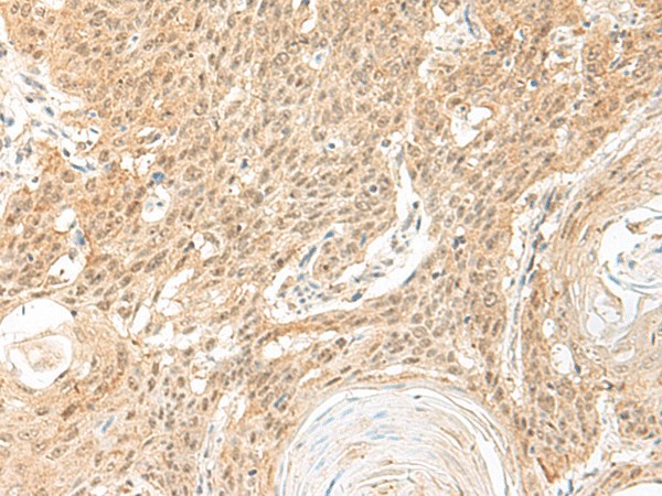 Immunohistochemistry of paraffin-embedded Human esophagus cancer tissue  using BICRA Polyclonal Antibody at dilution of 1:60(?200)