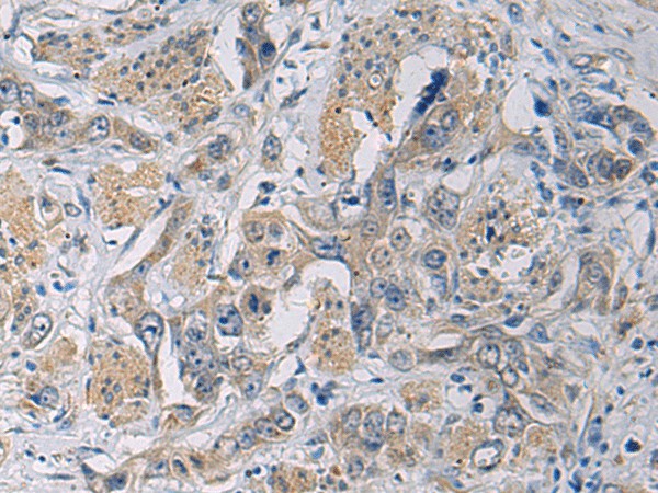 Immunohistochemistry of paraffin-embedded Human esophagus cancer tissue  using CYTIP Polyclonal Antibody at dilution of 1:50(?200)