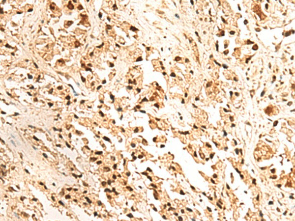 Immunohistochemistry of paraffin-embedded Human prost ate cancer tissue  using JPT2 Polyclonal Antibody at dilution of 1:65(?200)