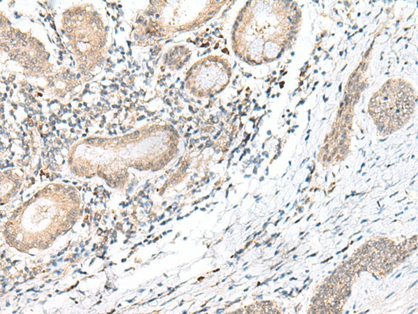 Immunohistochemistry of paraffin-embedded Human esophagus cancer tissue  using GANC Polyclonal Antibody at dilution of 1:45(?200)