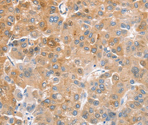 Immunohistochemistry of paraffin-embedded Human liver cancer tissue using CDR2 Polyclonal Antibody at dilution 1:60