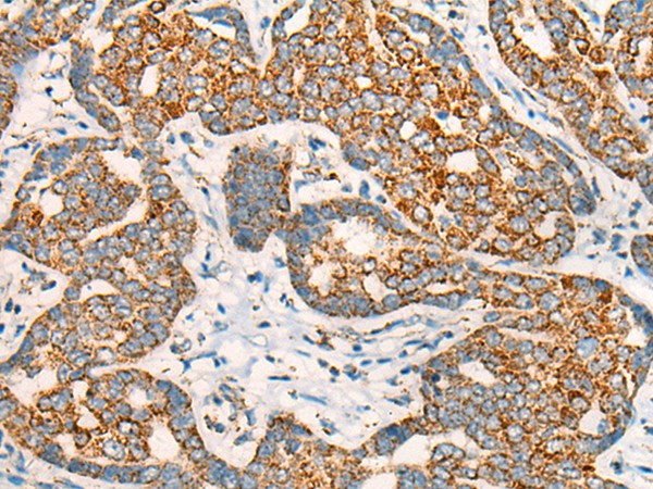 Immunohistochemistry of paraffin-embedded Human liver cancer tissue  using CCT8L2 Polyclonal Antibody at dilution of 1:45(?200)