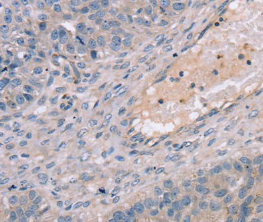 Immunohistochemistry of paraffin-embedded Human breast cancer using TERT Polyclonal Antibody at dilution of 1:35