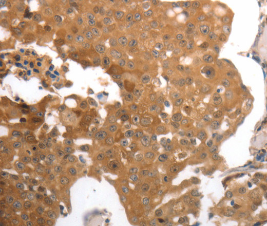 Immunohistochemistry of paraffin-embedded Human breast cancer using MMP27 Polyclonal Antibody at dilution of 1:40