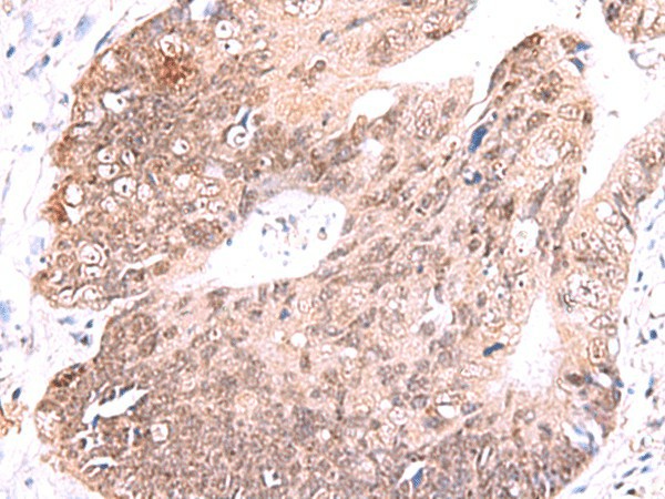 Immunohistochemistry of paraffin-embedded Human colorectal cancer tissue  using RUSC1 Polyclonal Antibody at dilution of 1:65(?200)