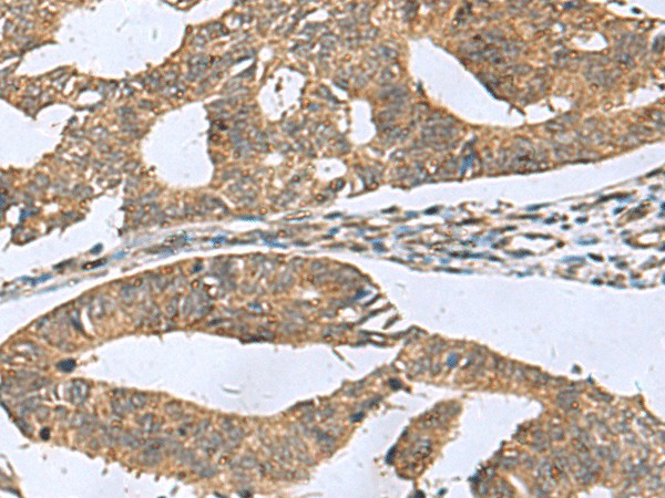 Immunohistochemistry of paraffin-embedded Human colorectal cancer tissue  using RPL18 Polyclonal Antibody at dilution of 1:70(?200)