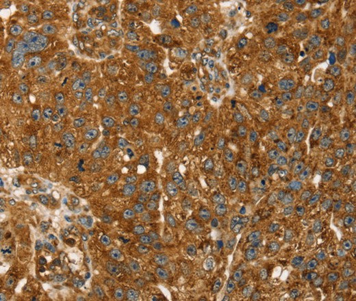 Immunohistochemistry of paraffin-embedded Human breast cancer tissue using TBC1D1 Polyclonal Antibody at dilution 1:45