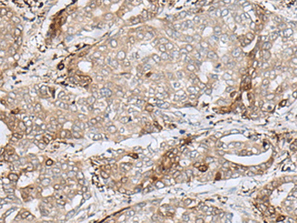 Immunohistochemistry of paraffin-embedded Human liver cancer tissue  using MRM1 Polyclonal Antibody at dilution of 1:85(?200)