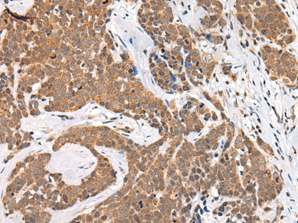 Immunohistochemistry of paraffin-embedded Human thyroid cancer tissue  using CHAMP1 Polyclonal Antibody at dilution of 1:40(?200)