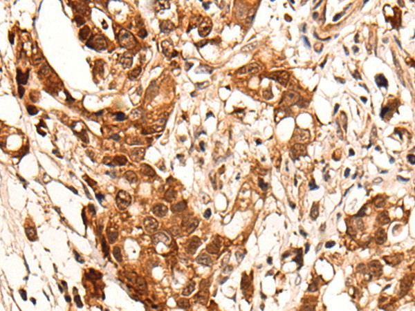 Immunohistochemistry of paraffin-embedded Human gastric cancer tissue  using HOXD8 Polyclonal Antibody at dilution of 1:40(?200)