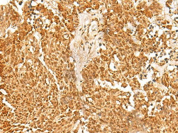 Immunohistochemistry of paraffin-embedded Human lung cancer tissue  using SSSCA1 Polyclonal Antibody at dilution of 1:50(?200)