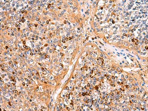 Immunohistochemistry of paraffin-embedded Human liver cancer tissue  using KANSL1L Polyclonal Antibody at dilution of 1:40(?200)