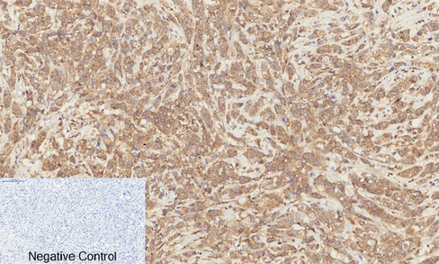 Immunohistochemistry of paraffin-embedded Human breast cancer tissue  using Phospho-Catenin beta (Ser37) Polyclonal Antibody at dilution of 1:200