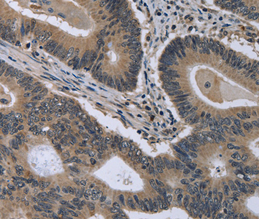 Immunohistochemistry of paraffin-embedded Human colon cancer using MCM3AP Polyclonal Antibody at dilution of 1:30