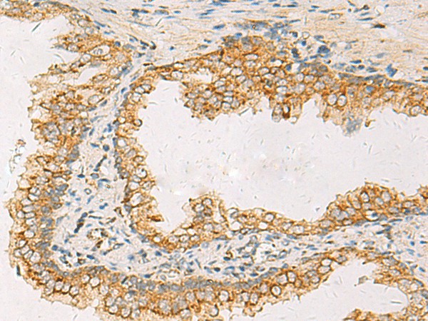 Immunohistochemistry of paraffin-embedded Human prost at e cancer tissue  using SUSD3 Polyclonal Antibody at dilution of 1:85(?200)