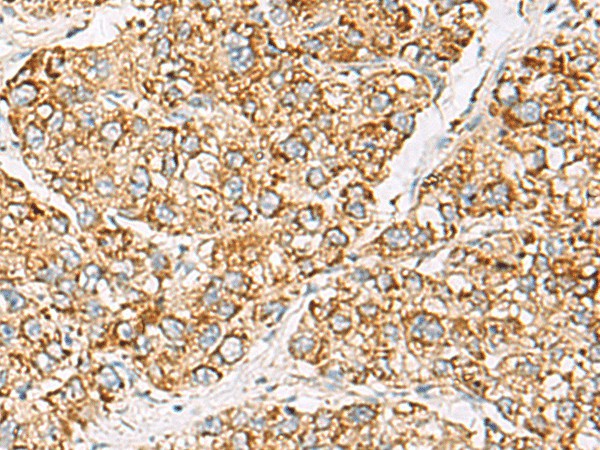 Immunohistochemistry of paraffin-embedded Human liver cancer tissue  using ZPBP2 Polyclonal Antibody at dilution of 1:50(?200)