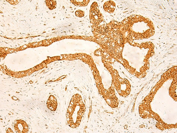 Immunohistochemistry of paraffin-embedded Human ovarian cancer tissue  using KRT76 Polyclonal Antibody at dilution of 1:50(?200)