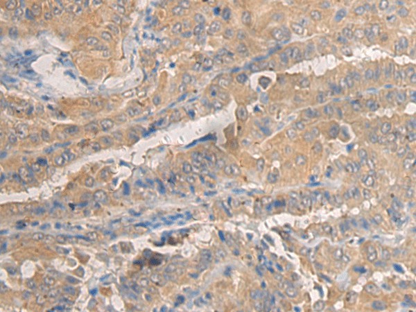 Immunohistochemistry of paraffin-embedded Human thyroid cancer tissue  using AGAP3 Polyclonal Antibody at dilution of 1:25(?200)