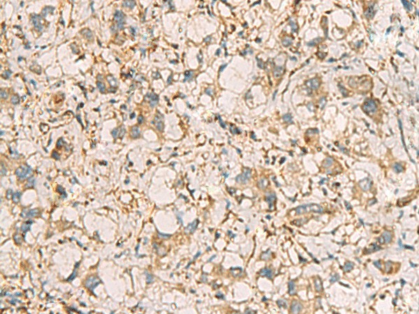 Immunohistochemistry of paraffin-embedded Human liver cancer tissue  using PRKRA Polyclonal Antibody at dilution of 1:65(?200)