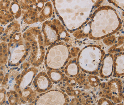 Immunohistochemistry of paraffin-embedded Human thyroid cancer using ITIH1 Polyclonal Antibody at dilution of 1:30