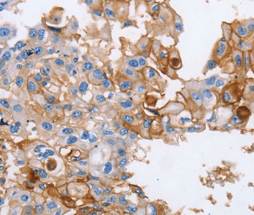 Immunohistochemistry of paraffin-embedded Human breast cancer using CD54 Polyclonal Antibody at dilution of 1:40