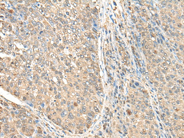 Immunohistochemistry of paraffin-embedded Human liver cancer tissue  using ASS1 Polyclonal Antibody at dilution of 1:35(?200)