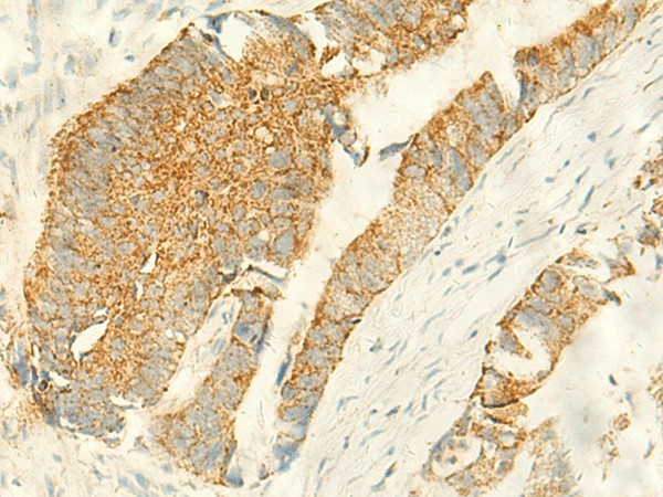 Immunohistochemistry of paraffin-embedded Human colorectal cancer tissue  using MPV17 Polyclonal Antibody at dilution of 1:50(?200)