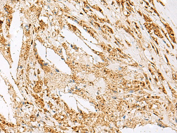 Immunohistochemistry of paraffin-embedded Human thyroid cancer tissue  using DNPEP Polyclonal Antibody at dilution of 1:60(?200)