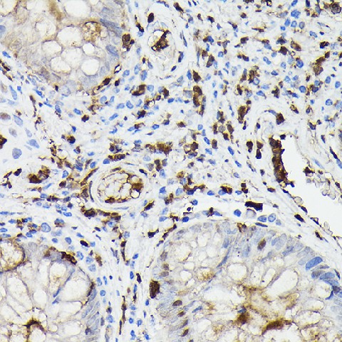 Immunohistochemistry of paraffin-embedded human colon carcinoma using Gelsolin Polyclonal Antibody at dilution of 1:50 (40x lens).Perform high pressure antigen retrieval with 10 mM citrate buffer pH 6.0 before commencing with IHC staining protocol.