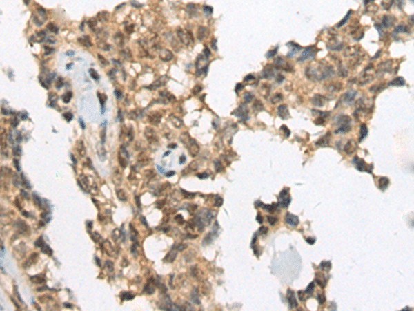 Immunohistochemistry of paraffin-embedded Human ovarian cancer tissue  using ATRX Polyclonal Antibody at dilution of 1:50(?200)