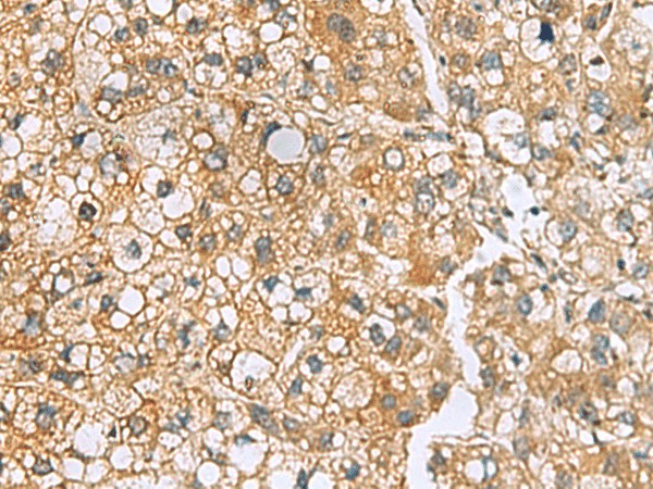 Immunohistochemistry of paraffin-embedded Human liver cancer tissue  using MRPL22 Polyclonal Antibody at dilution of 1:50(?200)